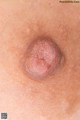 A close up of a woman's breast with a small lump on it.